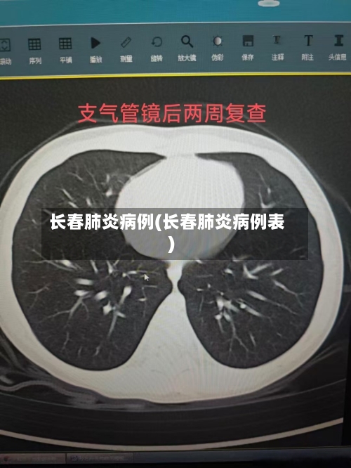 长春肺炎病例(长春肺炎病例表)-第2张图片