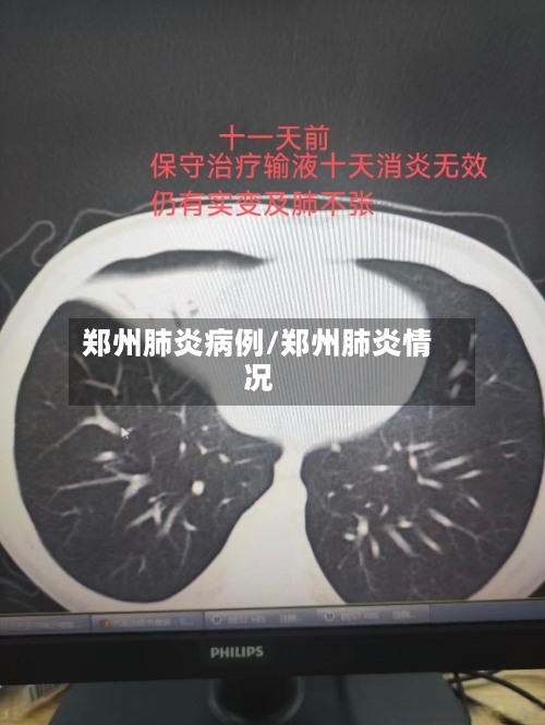 郑州肺炎病例/郑州肺炎情况